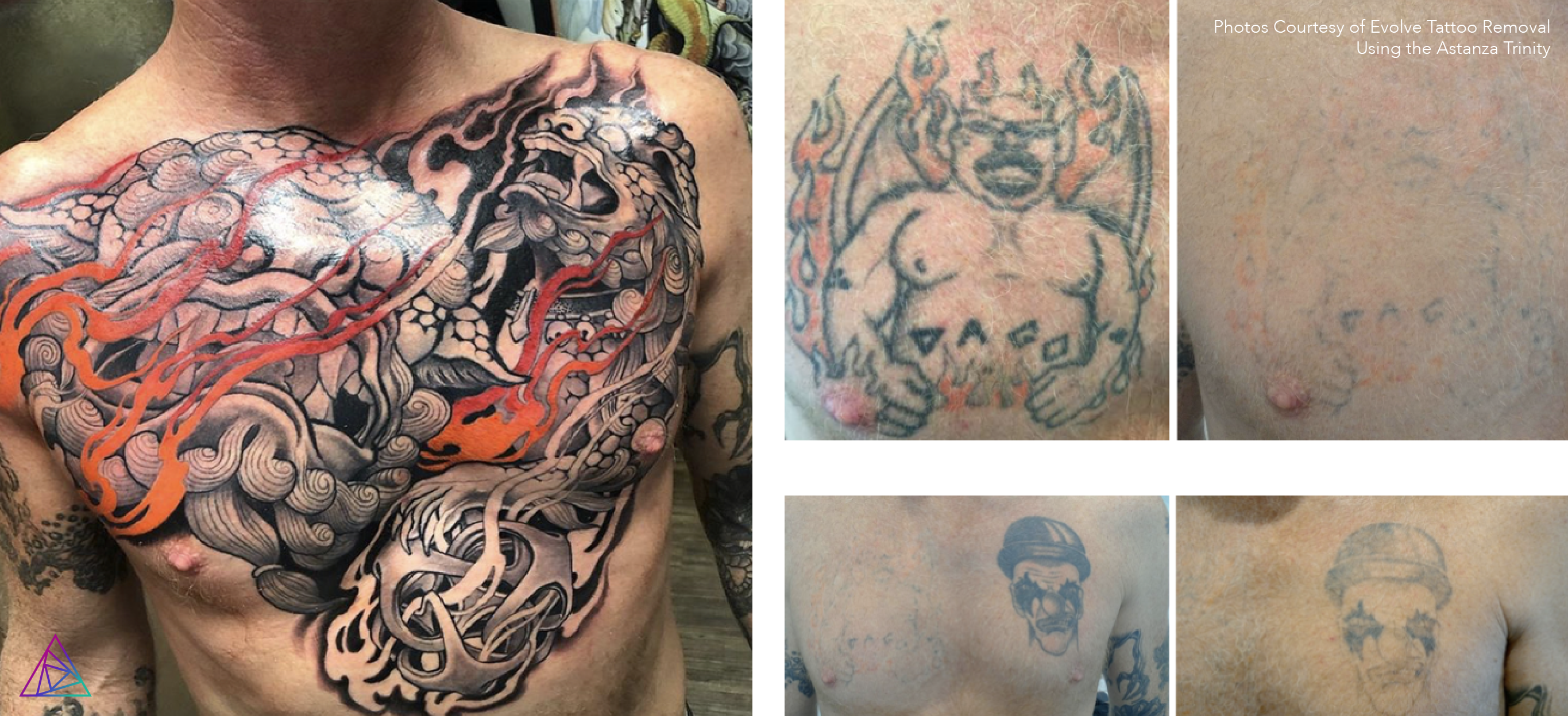 Before and after tattoo removal